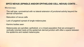 SPITZ NEVUS (SPINDLE AND/OR EPITHELIOID CELL NEVUS) CONTD…
Microscopy:
• The cell type, symmetrical with no lateral extension of junctional activity beyond the
dermal component
• Maturation of nevus cells
• Lack of pagetoid spread of single melanocytes
• Kamino bodies seen
• Melanocytes are spindled, epithelioid, or a mixed population that are arranged in
vertically oriented nests at the epidermal–dermal junction with often a space between
the epidermis and nested melanocytes
 