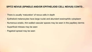 SPITZ NEVUS (SPINDLE AND/OR EPITHELIOID CELL NEVUS) CONTD...
• There is usually ‘maturation’ of nevus cells in depth
• Epithelioid melanocytes have large nuclei and abundant eosinophilic cytoplasm
• Numerous ectatic, thin-walled vascular spaces may be seen in the papillary dermis
• Superficial mitoses may be seen
• Pagetoid spread may be seen
 