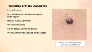 PIGMENTED SPINDLE CELL NEVUS
Clinical feature:
• Acquired lesion in the shoulder/ pelvic
girdle region
• Heavily evenly pigmented
• Well-circumscribed
• Small, deeply pigmented papule
• Women in their second and third decades
Gross photo of Pigmented
spindle shaped Nevus
 