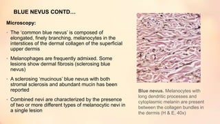 BLUE NEVUS CONTD…
Microscopy:
• The ‘common blue nevus’ is composed of
elongated, finely branching, melanocytes in the
interstices of the dermal collagen of the superficial
upper dermis
• Melanophages are frequently admixed. Some
lesions show dermal fibrosis (sclerosing blue
nevus)
• A sclerosing ‘mucinous’ blue nevus with both
stromal sclerosis and abundant mucin has been
reported
• Combined nevi are characterized by the presence
of two or more different types of melanocytic nevi in
a single lesion
Blue nevus. Melanocytes with
long dendritic processes and
cytoplasmic melanin are present
between the collagen bundles in
the dermis (H & E, 40x)
 