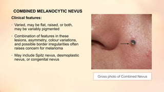 COMBINED MELANOCYTIC NEVUS
Clinical features:
• Varied, may be flat, raised, or both,
may be variably pigmented
• Combination of features in these
lesions, asymmetry, colour variations,
and possible border irregularities often
raises concern for melanoma
• May include Spitz nevus, desmoplastic
nevus, or congenital nevus
Gross photo of Combined Nevus
 