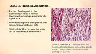CELLULAR BLUE NEVUS CONTD…
• Tumour often bulges into the
subcutaneous fat as a nodular
downgrowth which has a characteristic
appearance
• Nerve hypertrophy is often present with
perineural aggregation of cells
• Giant cellular blue nevus of the scalp
can be mistaken for a melanoma
Cellular blue nevus. There are nests and
fascicles of melanocytes, some with a spindle
shape. The cytoplasm of the cells is pale
staining. (H & E,40x)
 