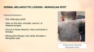 DERMAL MELANOCYTIC LESIONS - MONGOLIAN SPOT
Clinical features:
• Flat, slate-gray patch
• Seen on the face, shoulder, sacrum, or
bilateral temples
• Occurs in Asian descent, more commonly in
females
• Minocycline therapy may rarely simulate a
Mongolian spot
Gross photo showing
Mongolian Spot
 