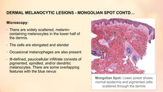 DERMAL MELANOCYTIC LESIONS - MONGOLIAN SPOT CONTD…
Microscopy:
• There are widely scattered, melanin-
containing melanocytes in the lower half of
the dermis.
• The cells are elongated and slender
• Occasional melanophages are also present
• Ill-defined, paucicellular infiltrate consists of
pigmented, spindled, and/or dendritic
melanocytes. There are some overlapping
features with the blue nevus
Mongolian Spot: Lower power shows
normal epidermis and pigmented cells
scattered through the dermis
 