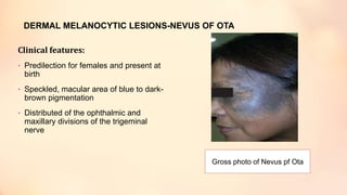 DERMAL MELANOCYTIC LESIONS-NEVUS OF OTA
Clinical features:
• Predilection for females and present at
birth
• Speckled, macular area of blue to dark-
brown pigmentation
• Distributed of the ophthalmic and
maxillary divisions of the trigeminal
nerve
Gross photo of Nevus pf Ota
 