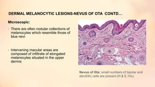 DERMAL MELANOCYTIC LESIONS-NEVUS OF OTA CONTD…
Microscopic:
• There are often nodular collections of
melanocytes which resemble those of
blue nevi
• Intervening macular areas are
composed of infiltrate of elongated
melanocytes situated in the upper
dermis
Nevus of Ota: small numbers of bipolar and
dendritic cells are present (H & E,10x).
 