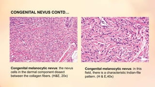 Congenital melanocytic nevus: in this
field, there is a characteristic Indian-file
pattern. (H & E,40x)
CONGENITAL NEVUS CONTD…
Congenital melanocytic nevus: the nevus
cells in the dermal component dissect
between the collagen fibers. (H&E, 20x)
 