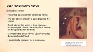 DEEP PENETRATING NEVUS
Clinical features:
• Regarded as a variant of congenital nevus
• The age at presentation is quite broad (3–64
years)
• Small, pigmented lesion < 1 cm diameter,
dome-shaped, blue or black papule or nodule
on the upper half of the body
• May resemble a blue nevus, usually acquired
during early adulthood
• Histologically mistaken for a melanoma
Gross photo of Deep
penetrating nevus
 