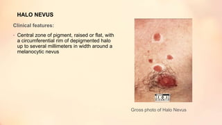 HALO NEVUS
Clinical features:
• Central zone of pigment, raised or flat, with
a circumferential rim of depigmented halo
up to several millimeters in width around a
melanocytic nevus
Gross photo of Halo Nevus
 