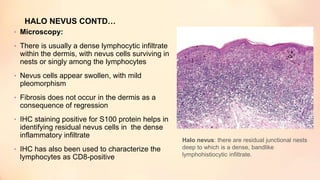 HALO NEVUS CONTD…
• Microscopy:
• There is usually a dense lymphocytic infiltrate
within the dermis, with nevus cells surviving in
nests or singly among the lymphocytes
• Nevus cells appear swollen, with mild
pleomorphism
• Fibrosis does not occur in the dermis as a
consequence of regression
• IHC staining positive for S100 protein helps in
identifying residual nevus cells in the dense
inflammatory infiltrate
• IHC has also been used to characterize the
lymphocytes as CD8-positive
Halo nevus: there are residual junctional nests
deep to which is a dense, bandlike
lymphohistiocytic infiltrate.
 