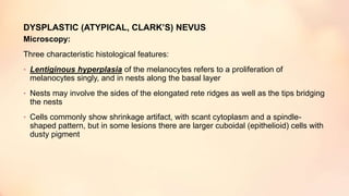 DYSPLASTIC (ATYPICAL, CLARK’S) NEVUS
Microscopy:
Three characteristic histological features:
• Lentiginous hyperplasia of the melanocytes refers to a proliferation of
melanocytes singly, and in nests along the basal layer
• Nests may involve the sides of the elongated rete ridges as well as the tips bridging
the nests
• Cells commonly show shrinkage artifact, with scant cytoplasm and a spindle-
shaped pattern, but in some lesions there are larger cuboidal (epithelioid) cells with
dusty pigment
 