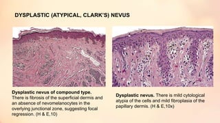 DYSPLASTIC (ATYPICAL, CLARK’S) NEVUS
Dysplastic nevus of compound type.
There is fibrosis of the superficial dermis and
an absence of nevomelanocytes in the
overlying junctional zone, suggesting focal
regression. (H & E,10)
Dysplastic nevus. There is mild cytological
atypia of the cells and mild fibroplasia of the
papillary dermis. (H & E,10x)
 