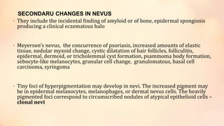 SECONDARU CHANGES IN NEVUS
• They include the incidental finding of amyloid or of bone, epidermal spongiosis
producing a clinical eczematous halo
• Meyerson’s nevus, the concurrence of psoriasis, increased amounts of elastic
tissue, nodular myxoid change, cystic dilatation of hair follicles, folliculitis,
epidermal, dermoid, or tricholemmal cyst formation, psammoma body formation,
sebocyte-like melanocytes, granular cell change, granulomatous, basal cell
carcinoma, syringoma
• Tiny foci of hyperpigmentation may develop in nevi. The increased pigment may
be in epidermal melanocytes, melanophages, or dermal nevus cells. The heavily
pigmented foci correspond to circumscribed nodules of atypical epithelioid cells –
clonal nevi
 