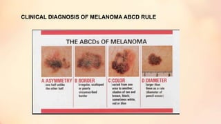 CLINICAL DIAGNOSIS OF MELANOMA ABCD RULE
 