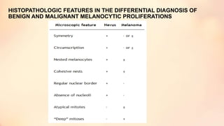 HISTOPATHOLOGIC FEATURES IN THE DIFFERENTIAL DIAGNOSIS OF
BENIGN AND MALIGNANT MELANOCYTIC PROLIFERATIONS
 