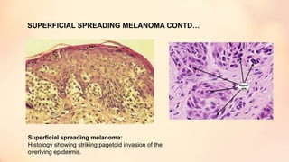 SUPERFICIAL SPREADING MELANOMA CONTD…
Superficial spreading melanoma:
Histology showing striking pagetoid invasion of the
overlying epidermis.
 