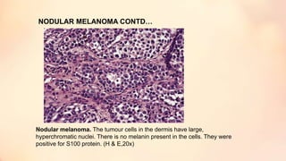 NODULAR MELANOMA CONTD…
Nodular melanoma. The tumour cells in the dermis have large,
hyperchromatic nuclei. There is no melanin present in the cells. They were
positive for S100 protein. (H & E,20x)
 