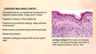 LENTIGO MALIGNA CONTD…
• Characterized by an epidermal component of
atypical melanocytes, singly and in nests
• Pagetoid invasion of the epidermis
• Presence of junctional nesting, deep adnexal
involvement
• Melanocytes is present above the basal layer
• Epidermal atrophy
• Variable cytological atypia with tumour giant
cells Lentigo maligna:The nuclei are irregular,
angular, and hyperchromatic; and there is
early pagetoid spread. (H & E, 40x)
 