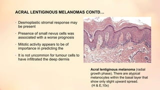 ACRAL LENTIGINOUS MELANOMAS CONTD…
• Desmoplastic stromal response may
be present
• Presence of small nevus cells was
associated with a worse prognosis
• Mitotic activity appears to be of
importance in predicting the
• It is not uncommon for tumour cells to
have infiltrated the deep dermis
Acral lentiginous melanoma (radial
growth phase). There are atypical
melanocytes within the basal layer that
show only slight upward spread.
(H & E,10x)
 