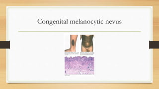 Melanocytic tumors-nevus and malignant melanoma | PPTX