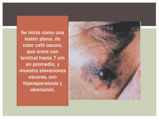 Se inicia como una
lesión plana, de
color café oscuro,
que crece con
lentitud hasta 7 cm
en promedio, y
muestra elevaciones
oscuras, con
hiperqueratosis y
ulceración.

 