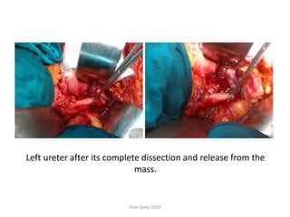 Left ureter after its complete dissection and release from the
mass.
Ihab Samy 2014
 