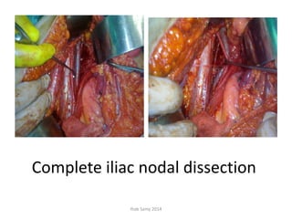 Complete iliac nodal dissection
Ihab Samy 2014
 