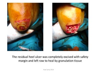 The residual heel ulcer was completely excised with safety
margin and left raw to heal by granulation tissue
Ihab Samy 2014
 