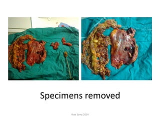 Specimens removed
Ihab Samy 2014
 