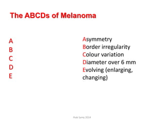 A
B
C
D
E
Asymmetry
Border irregularity
Colour variation
Diameter over 6 mm
Evolving (enlarging,
changing)
The ABCDs of Melanoma
Ihab Samy 2014
 