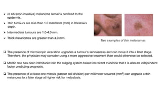  In situ (non-invasive) melanoma remains confined to the 
epidermis. 
 Thin tumours are less than 1.0 millimeter (mm) in Breslow’s 
depth. 
 Intermediate tumours are 1.0-4.0 mm. 
 Thick melanomas are greater than 4.0 mm. 
 The presence of microscopic ulceration upgrades a tumour’s seriousness and can move it into a later stage. 
Therefore, the physician may consider using a more aggressive treatment than would otherwise be selected. 
 Mitotic rate has been introduced into the staging system based on recent evidence that it is also an independent 
factor predicting prognosis. 
 The presence of at least one mitosis (cancer cell division) per millimeter squared (mm2) can upgrade a thin 
melanoma to a later stage at higher risk for metastasis. 
Two examples of thin melanomas 
 