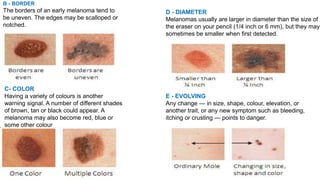 B - BORDER 
The borders of an early melanoma tend to 
be uneven. The edges may be scalloped or 
notched. 
C- COLOR 
Having a variety of colours is another 
warning signal. A number of different shades 
of brown, tan or black could appear. A 
melanoma may also become red, blue or 
some other colour 
D - DIAMETER 
Melanomas usually are larger in diameter than the size of 
the eraser on your pencil (1/4 inch or 6 mm), but they may 
sometimes be smaller when first detected. 
E - EVOLVING 
Any change — in size, shape, colour, elevation, or 
another trait, or any new symptom such as bleeding, 
itching or crusting — points to danger. 
 