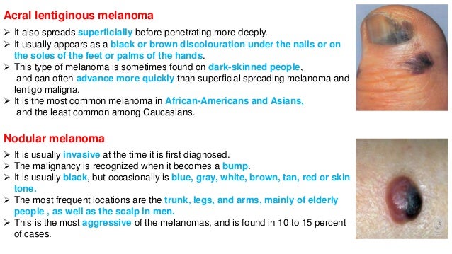 Acral Lentiginous Melanoma Nail Symptoms - Nail Ftempo