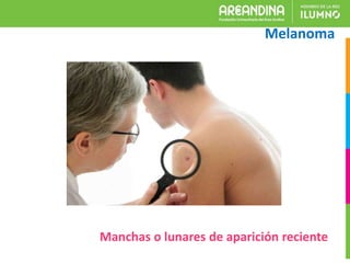 Melanoma
Manchas o lunares de aparición reciente
 