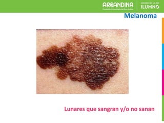 Melanoma
Lunares que sangran y/o no sanan
 