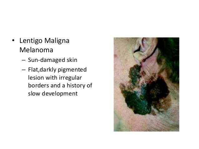 39+ Oral Malignant Melanoma Slideshare Images
