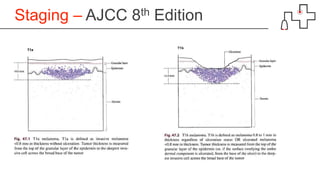 Staging – AJCC 8th Edition
 