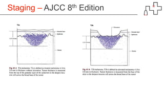 Staging – AJCC 8th Edition
 