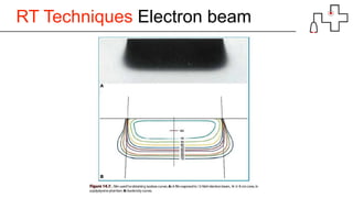 RT Techniques Electron beam
 