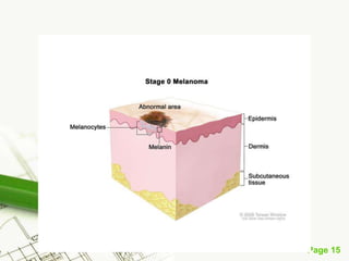 Melanoma (malignant melanoma)