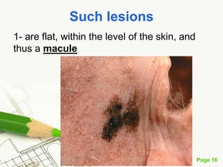 Melanoma (malignant melanoma)