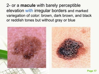Melanoma (malignant melanoma)