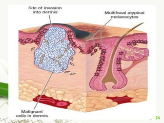 Melanoma (malignant melanoma)