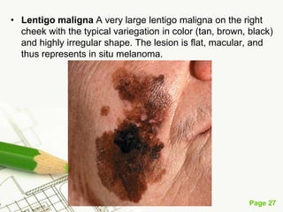 Melanoma (malignant melanoma)