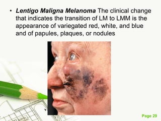 Melanoma (malignant melanoma)