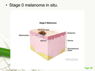 Melanoma (malignant melanoma)