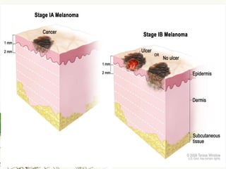 Melanoma (malignant melanoma)