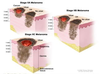 Melanoma (malignant melanoma)