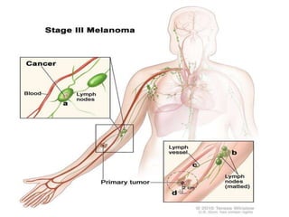 Melanoma (malignant melanoma)