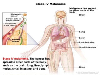 Melanoma (malignant melanoma)